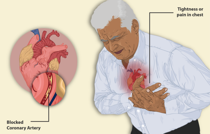 Angina Pectorala Cauze Simptome Si Tratament Bodygeek The Best Porn