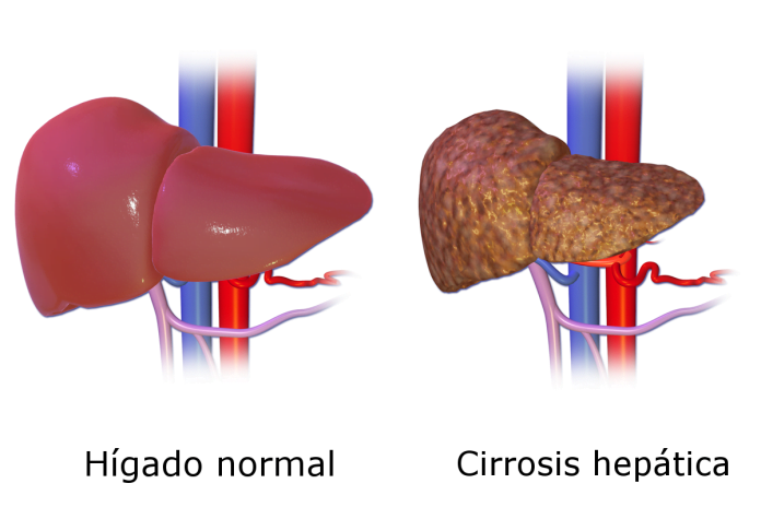 Ciroza Hepatica Cauze Simptome Si Tratament Bodygeek