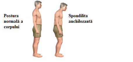 Spondilita anchilozantă, Foto: physioworks.com.au