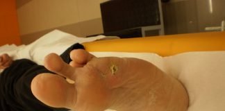 Ai bătături? Vezi ce tratamente există Ai bătături Vezi ce tratamente există