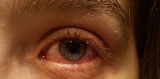 Ai conjunctivită? Citește aici care sunt simptomele și ce tratament trebuie să urmezi Ai conjunctivită Citește aici care sunt simptomele și ce tratament trebuie să urmezi