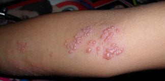 Ai herpes și nu știi ce să mai faci, descoperă aici cum erupe această boala și ce poți face Ai herpes și nu știi ce să mai faci, descoperă aici cum erupe această boala și ce poți face