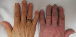 Anemia feriprivă, învață cum se depistează Anemia feriprivă, învață cum se depistează