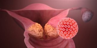 Cancerul de col uterin afectează tot mai multe femei, vezi ce rămâne de făcut Cancerul de col uterin afectează tot mai multe femei, vezi ce rămâne de făcut