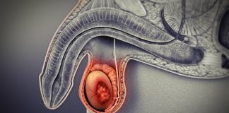 Cancerul testicular Cancerul testicular