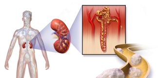 Cancerului renal, vezi aici ce simptome apar Cancerului renal, vezi aici ce simptome apar