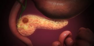 Care sunt primele simptome ce indică cancerul pancreatic Care sunt primele simptome ce indică cancerul pancreatic