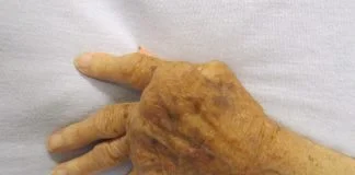 Ce presupune artrita reumatoidă și care sunt efectele acestei afecțiuni