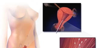 Citește totul despre tehnicile de inseminare artificială