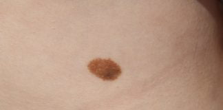 Cum pot deveni alunitele periculoase pentru sanatatea ta Cum pot deveni alunitele periculoase pentru sanatatea ta