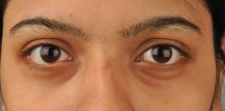 Din ce cauză apar cearcănele și care sunt cele mai indicate tratamente Din ce cauză apar cearcănele și care sunt cele mai indicate tratamente