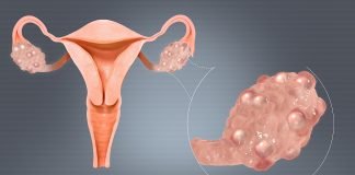 Ovare polichistice, descoperă cauzele, simptomele și metodele de tratament Ovare polichistice, descoperă cauzele, simptomele și metodele de tratament