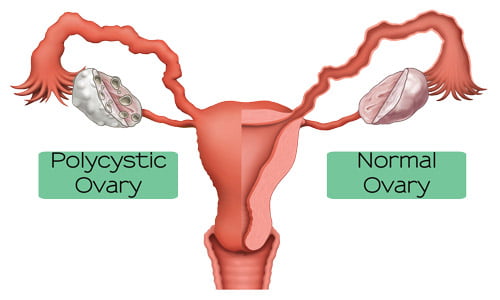 Sindromul ovarelor polichistice, dieta și nutriția.