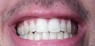 Vrei o dantură frumoasă? Vezi cum se pot albi dinții în mod natural Vrei o dantură frumoasă Vezi cum se pot albi dinții în mod natural