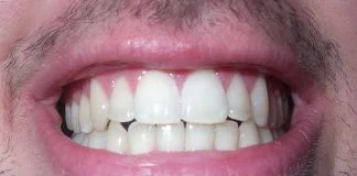 Vrei o dantură frumoasă? Vezi cum se pot albi dinții în mod natural Vrei o dantură frumoasă Vezi cum se pot albi dinții în mod natural
