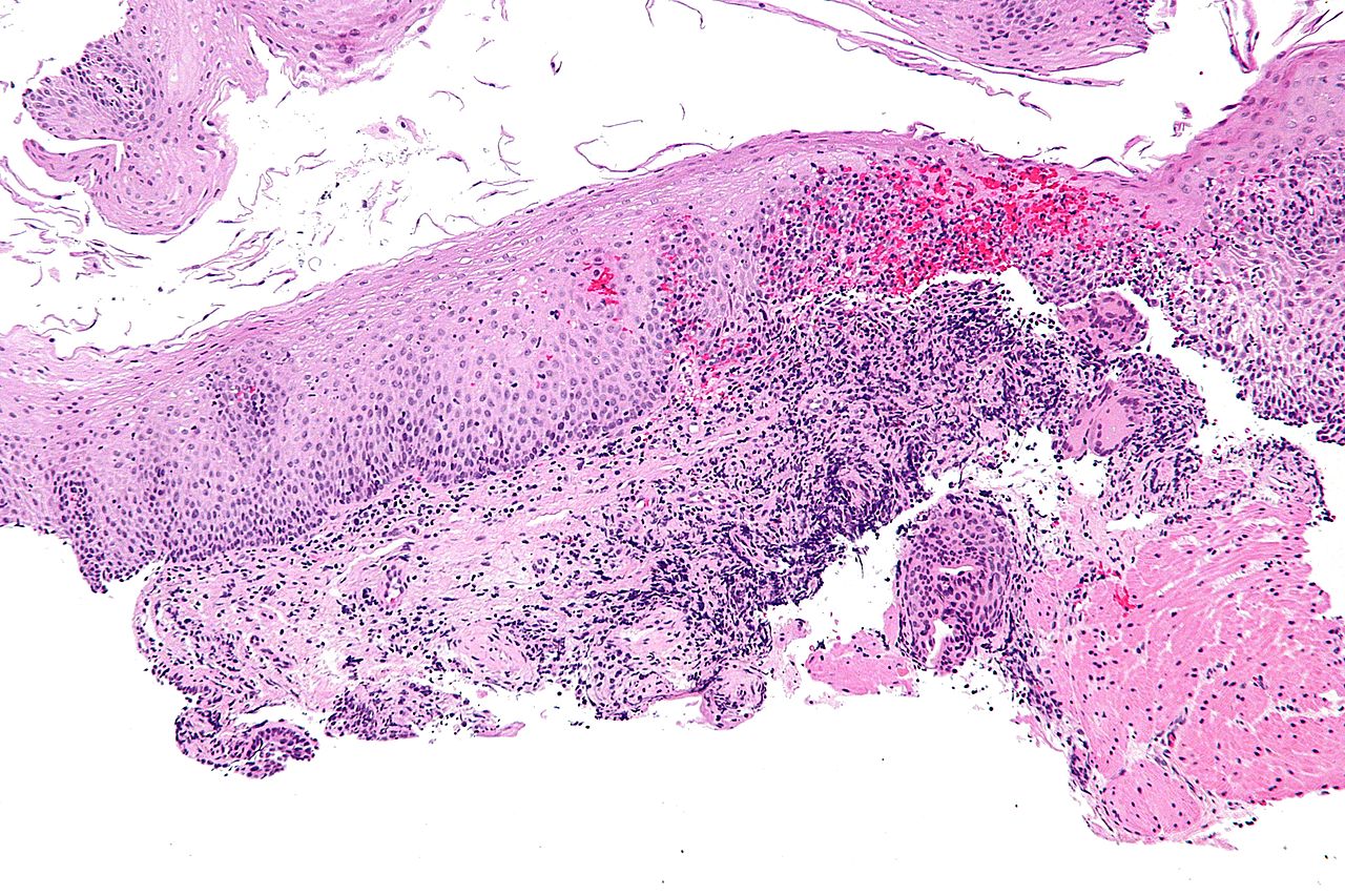 boala Crohn
