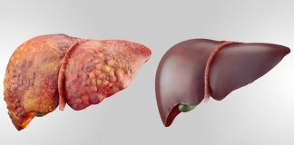 Detoxifierea ficatului – un pas spre sănătate