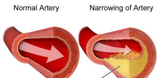 Ateroscleroza - Boala arterelor