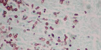 Candidoza - cauze si simptome