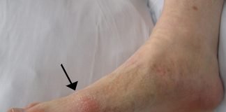 Care sunt stadiile de manifestare a gutei și ce presupune această afecțiune