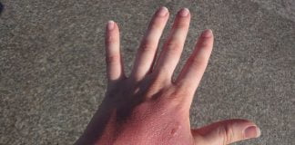 De câte feluri sunt arsurile și cum să te protejezi de ele