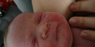 Dermatita atopica la bebelusi