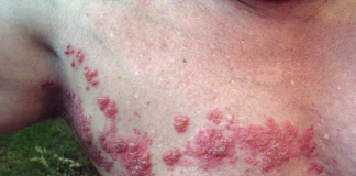 Zona zoster, o recidiva a varicelei