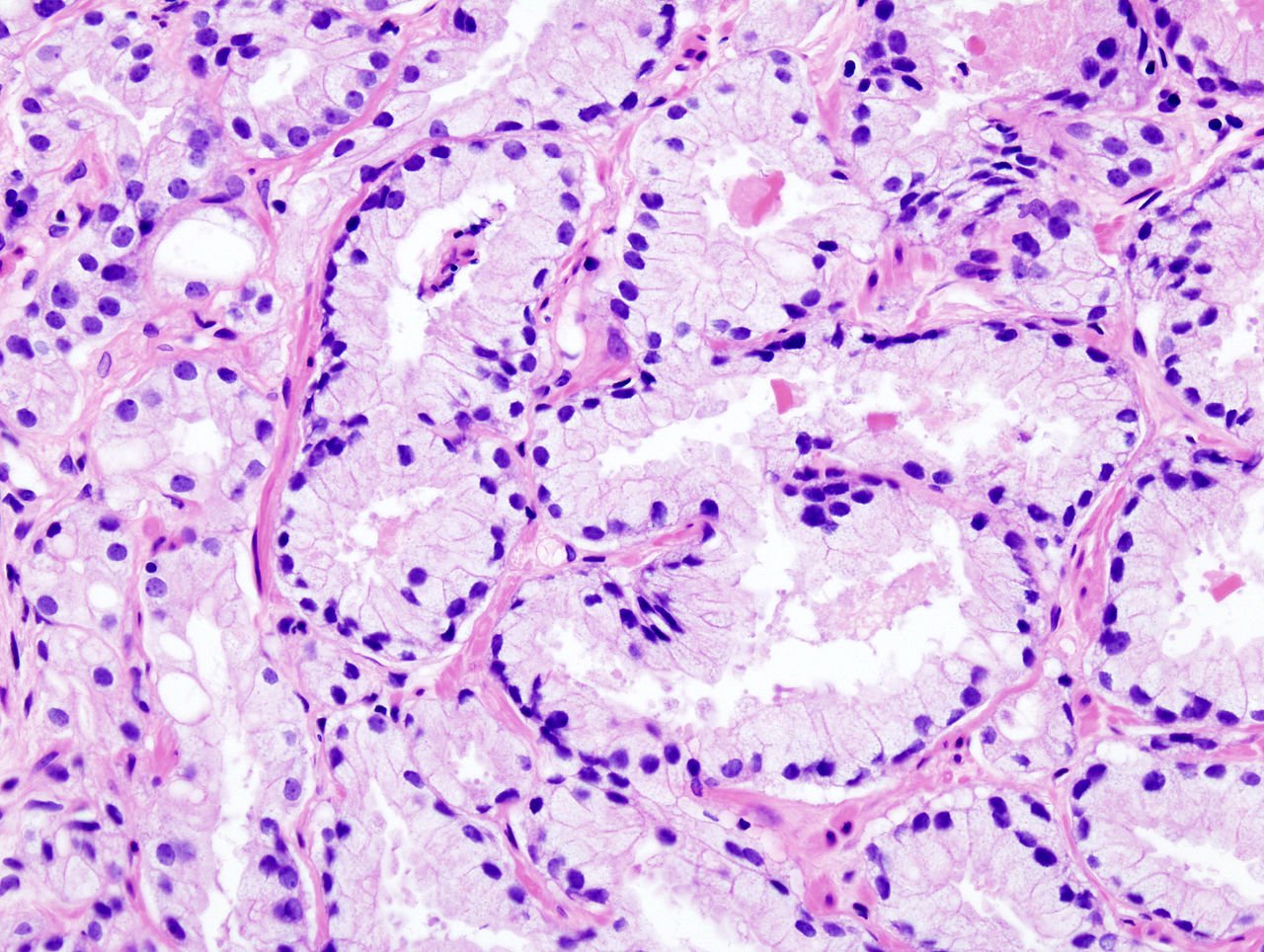 adenom de prostata