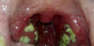 Amigdalita - povara sezonului rece