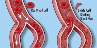 Anemia falciforma – o boala grava si dureroasa Anemia falciforma - o boala grava si dureroasa