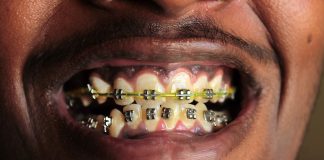Aparatul dentar: sacrificiu pentru sanatate sau pentru frumusete? Aparatul dentar sacrificiu pentru sanatate sau pentru frumusete