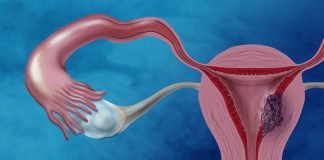 Cancer uterin – o boala a femeilor mature Cancer uterin - o boala a femeilor mature