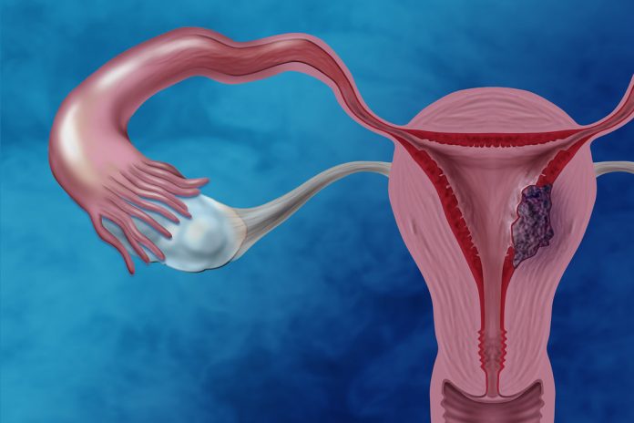 Cancer uterin - o boala a femeilor mature