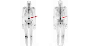 Cancerul osos - aspecte principale