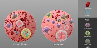 Cauzele leucemiei si tratarea ei