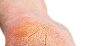 Cum tratezi calcaiele uscate?! Sfaturi utile Cum tratezi calcaiele uscate Sfaturi utile