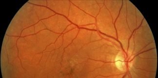 Degenerescenta maculara - metode de tratament