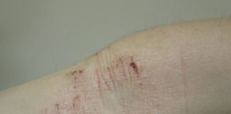 Dermatita atopica - Boala pielii