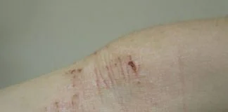 Dermatita atopica - Boala pielii