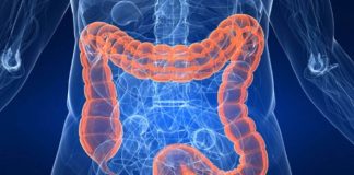 Diverticulita - Boala intestinului