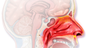 Febra de fan - rinita alergica