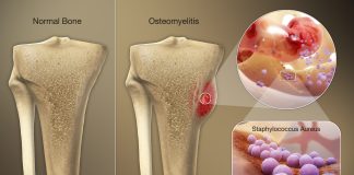 Infectiile stafilococice