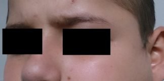 Oreionul sau parotidita epidemica Oreionul sau parotidita epidemica