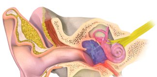 Otita medie, afectiune a urechii Otita medie, afectiune a urechii