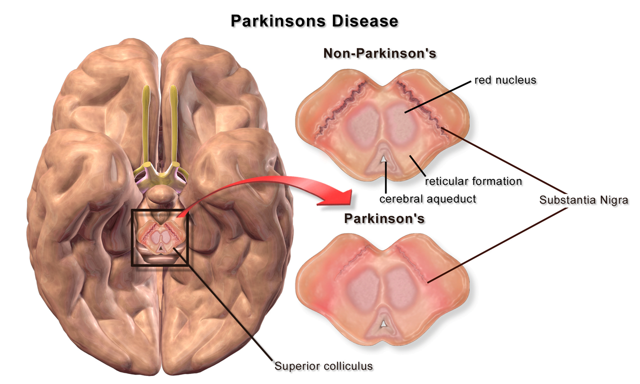Parkinson