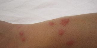 Reactii la intepaturi de insecte si paianjeni