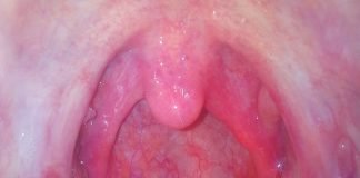 Rosu in gat – faringita Rosu in gat - faringita