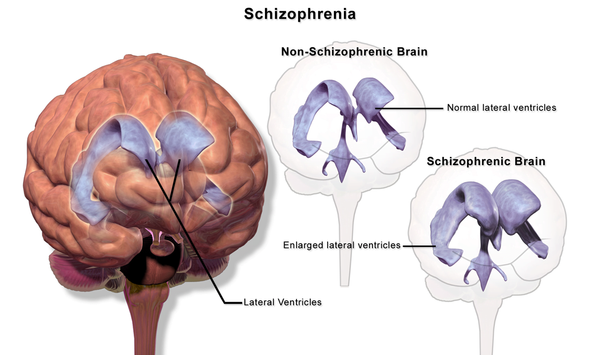 Schizofrenia