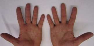 Septicemia - Cauze si metode de tratament