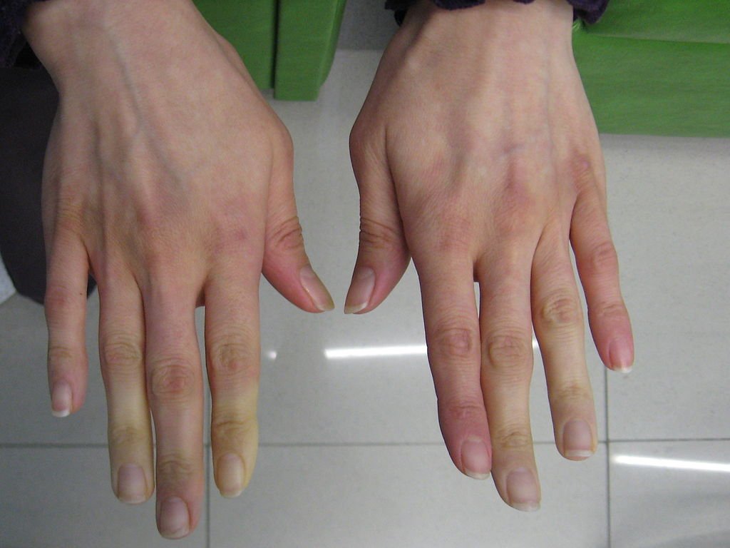Sindromul Raynaud